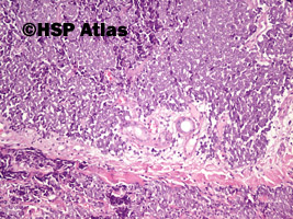 8. Rak z komórek Merkla (Merkel cell carcinoma), 10x