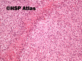 10. Malignant peripheral nerve sheath tumor (MPNST), 10x