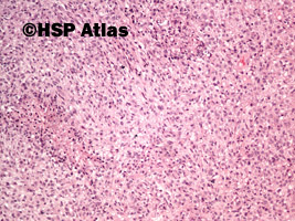 11. Malignant peripheral nerve sheath tumor (MPNST), 10x