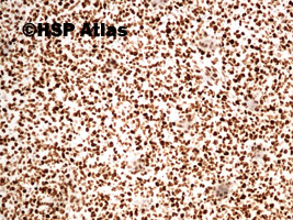 15. Ki67, Malignant peripheral nerve sheath tumor (MPNST), 10x