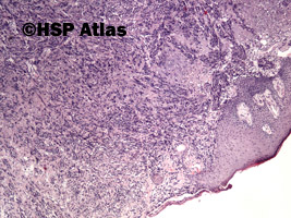 2. Malignant peripheral nerve sheath tumor (MPNST), 4x