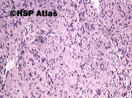 4. Malignant peripheral nerve sheath tumor (MPNST), 10x