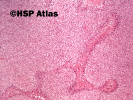 9. Malignant peripheral nerve sheath tumor (MPNST), 4x