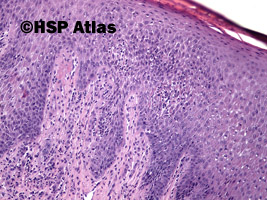 3. Mycosis fungoides, 10x
