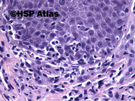 7. Mycosis fungoides, 40x