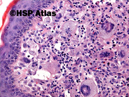 2. Żółtakoziarniniak młodzieńczy - komórki olbrzymie typu Toutona (xanthogranuloma juvenile - Touton giant cells), 20x