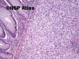 4. Mięśniakomięsak gładkokomórkowy okrężnicy (leiomyosarcoma), 10x
