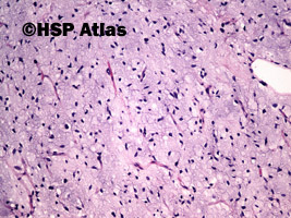 2. Well differentiated myxoid liposarcoma, 10x