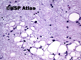 4. Well differentiated myxoid liposarcoma, 20x