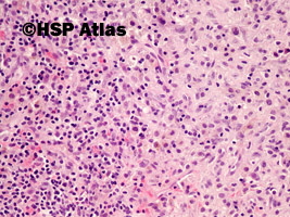 6. Myofibroblastyczny guz zapalny (inflammatory myofibroblastic tumor), 20x