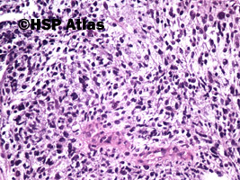 4. Mięśniakomięsak prążkowanokomórkowy, typ zarodkowy (embryonal rhabdomyosarcoma), 20x