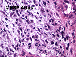 8. Mięśniakomięsak prążkowanokomórkowy, typ zarodkowy (embryonal rhabdomyosarcoma), 40x