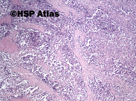 1. Mięśniakomięsak prążkowanokomórkowy, typ pęcherzykowy (alveolar rhabdomyosarcoma), 4x