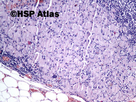 16. Komponenta zróżnicowanych rabdomioblastów w nawrotowym guzie - zmiany w przebiegu leczenia, 10x