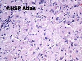 19. Rhabdomyosarcoma consisting almost entirely of differentiated rhabdomyoblasts, a feature encountered in recurrent tumors following therapy, 20x
