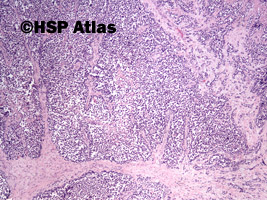 2. Mięśniakomięsak prążkowanokomórkowy, typ pęcherzykowy (alveolar rhabdomyosarcoma), 4x
