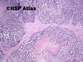 3. Mięśniakomięsak prążkowanokomórkowy, typ pęcherzykowy (alveolar rhabdomyosarcoma), 4x