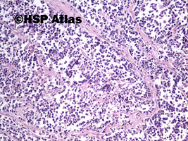 4. Mięśniakomięsak prążkowanokomórkowy, typ pęcherzykowy (alveolar rhabdomyosarcoma), 10x