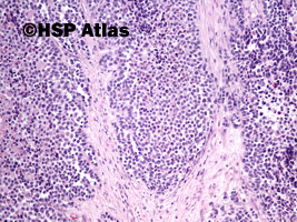 5. Mięśniakomięsak prążkowanokomórkowy, typ pęcherzykowy (alveolar rhabdomyosarcoma), 10x