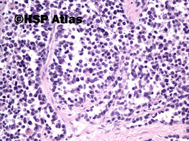 6. Mięśniakomięsak prążkowanokomórkowy, typ pęcherzykowy (alveolar rhabdomyosarcoma), 20x