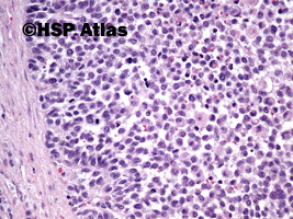 7. Mięśniakomięsak prążkowanokomórkowy, typ pęcherzykowy (alveolar rhabdomyosarcoma), 20x