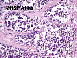 8. Mięśniakomięsak prążkowanokomórkowy, typ pęcherzykowy (alveolar rhabdomyosarcoma), 20x