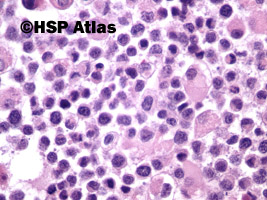 9. Mięśniakomięsak prążkowanokomórkowy, typ pęcherzykowy (alveolar rhabdomyosarcoma), 40x