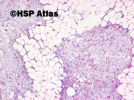 1. Tłuszczak wrzecinowatokomórkowy (spindle cell lipoma)