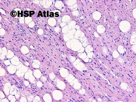 3. Tłuszczak wrzecinowatokomórkowy (spindle cell lipoma)
