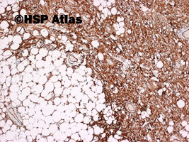 4. Tłuszczak wrzecinowatokomórkowy (spindle cell lipoma), CD34
