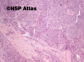 1. Guz olbrzymiokomórkowy pochewki ścięgnistej (giant cell tumor of tendon sheath), 4x