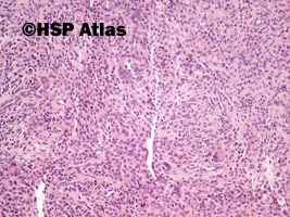 3. Guz olbrzymiokomórkowy pochewki ścięgnistej (giant cell tumor of tendon sheath), 10x
