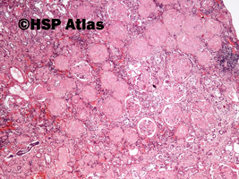 1. Amyloidoza (renal amyloidosis), 4x