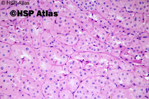 3. Chromophobe renal cell carcinoma - oxyphilic variant, 40x