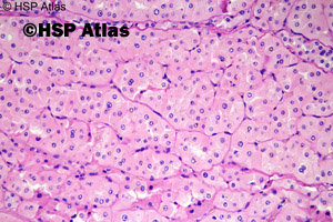 5. Chromophobe renal cell carcinoma - oxyphilic variant, 40x