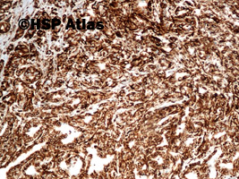 9. Vimentin, collecting duct carcinoma, 10x