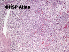 1. Rak jasnokomórkowy nerki, 2 stopień wg Fuhrmana (Clear Cell Renal Cell Carcinoma, Fuhrman Nuclear Grade 2), 4x