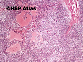2. Rak jasnokomórkowy nerki, 2 stopień wg Fuhrmana (Clear Cell Renal Cell Carcinoma, Fuhrman Nuclear Grade 2), 4x