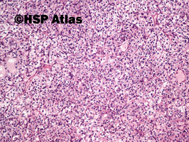 3. Rak jasnokomórkowy nerki, 2 stopień wg Fuhrmana (Clear Cell Renal Cell Carcinoma, Fuhrman Nuclear Grade 2), 10x