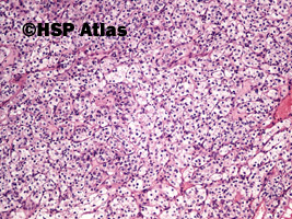 4. Rak jasnokomórkowy nerki, 2 stopień wg Fuhrmana (Clear Cell Renal Cell Carcinoma, Fuhrman Nuclear Grade 2), 10x