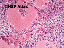 5. Rak jasnokomórkowy nerki, 2 stopień wg Fuhrmana (Clear Cell Renal Cell Carcinoma, Fuhrman Nuclear Grade 2), 10x