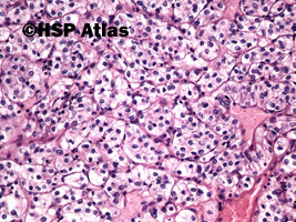 6. Rak jasnokomórkowy nerki, 2 stopień wg Fuhrmana (Clear Cell Renal Cell Carcinoma, Fuhrman Nuclear Grade 2), 20x