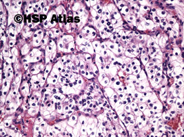 7. Rak jasnokomórkowy nerki, 2 stopień wg Fuhrmana (Clear Cell Renal Cell Carcinoma, Fuhrman Nuclear Grade 2), 20x