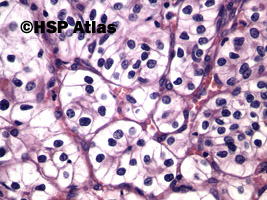 8. Rak jasnokomórkowy nerki, 2 stopień wg Fuhrmana (Clear Cell Renal Cell Carcinoma, Fuhrman Nuclear Grade 2), 40x