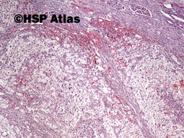 1. Rak jasnokomórkowy nerki, 3 stopień wg Fuhrmana (Clear Cell Renal Cell Carcinoma, Fuhrman Nuclear Grade 3), 4x