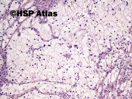 2. Rak jasnokomórkowy nerki, 3 stopień wg Fuhrmana (Clear Cell Renal Cell Carcinoma, Fuhrman Nuclear Grade 3), 10x