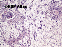 3. Rak jasnokomórkowy nerki, 3 stopień wg Fuhrmana (Clear Cell Renal Cell Carcinoma, Fuhrman Nuclear Grade 3), 10x