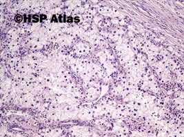 4. Rak jasnokomórkowy nerki, 3 stopień wg Fuhrmana (Clear Cell Renal Cell Carcinoma, Fuhrman Nuclear Grade 3), 10x