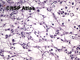 5. Rak jasnokomórkowy nerki, 3 stopień wg Fuhrmana (Clear Cell Renal Cell Carcinoma, Fuhrman Nuclear Grade 3), 20x