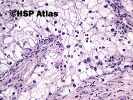 6. Rak jasnokomórkowy nerki, 3 stopień wg Fuhrmana (Clear Cell Renal Cell Carcinoma, Fuhrman Nuclear Grade 3), 20x